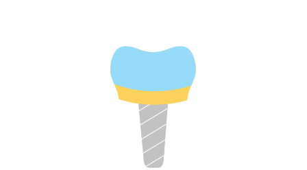 Verblendkrone