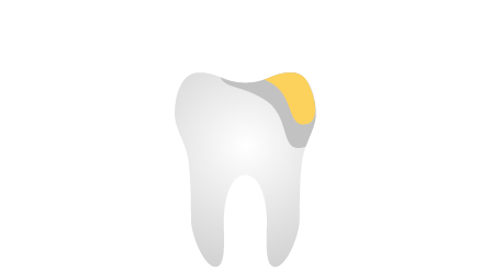 Goldinlay